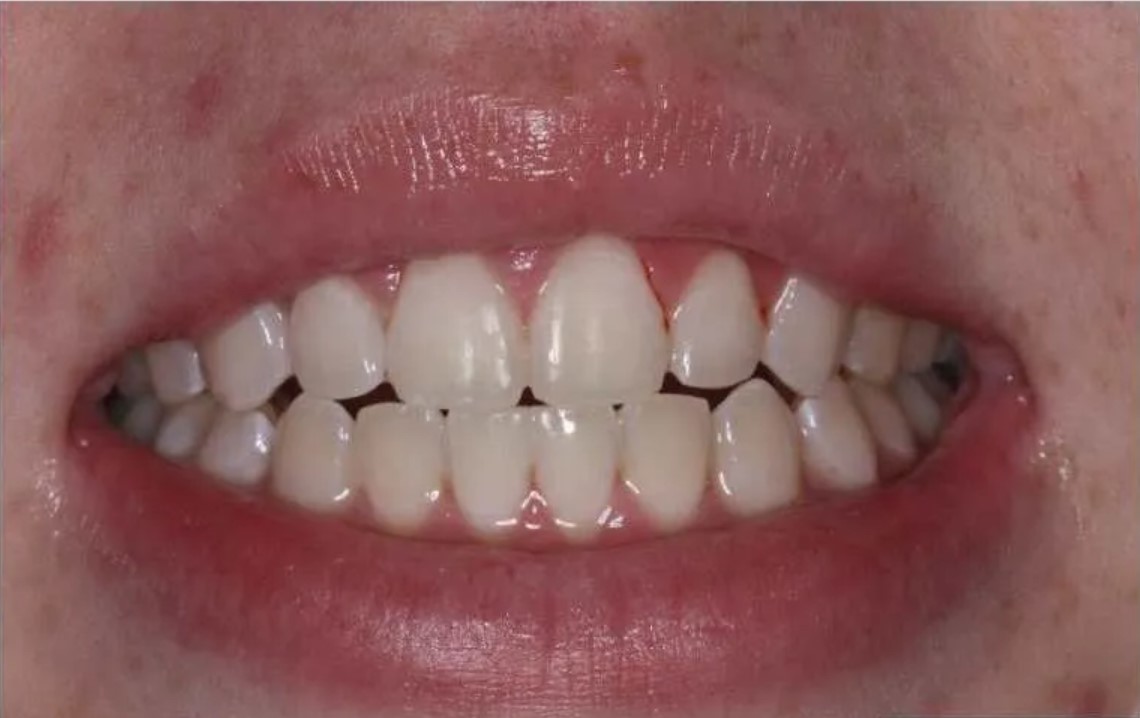 Before — teeth prior to professional dental scaling and polishing