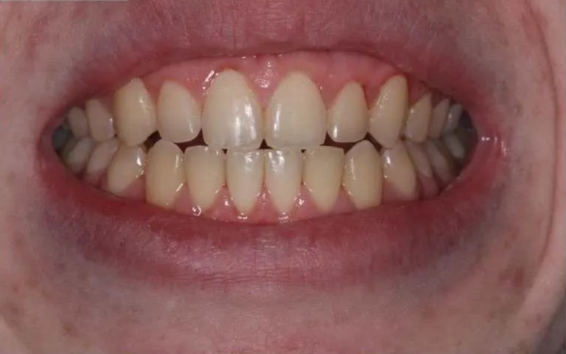 After — bright white smile following Epitome Dental Care treatment